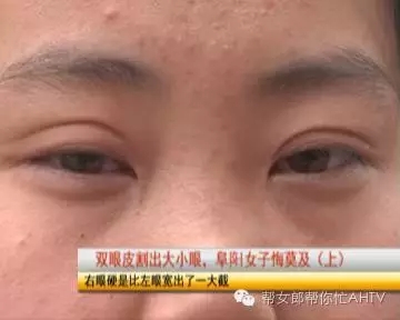 割双眼皮割出的大小眼