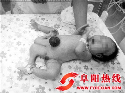 男婴长四条腿 两个生殖器遭父母遗弃